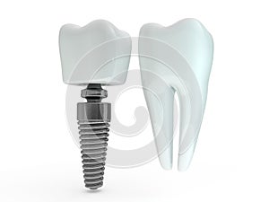 Dental implant dentist, tooth layout, plastics, man, teeth, treatment. 3D photo