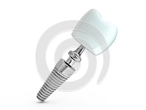 Dental implant dentist, tooth layout, plastics, man, teeth, treatment. 3D photo