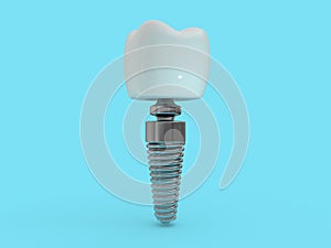 Dental implant dentist, tooth layout, plastics, man, teeth, treatment. 3D photo