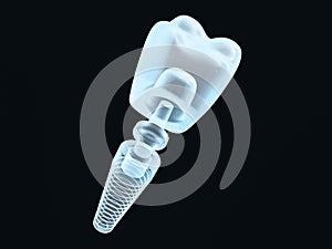 Dental implant dentist, tooth layout, plastics, man, teeth, treatment. 3D photo