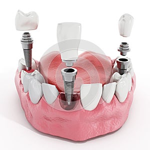 Dental implant detail photo