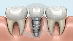 Dental implant embedded between natural teeth in jaw illustration