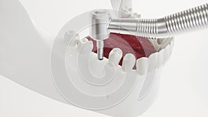 Dental implant on the example of a jaw model - 3D rendering