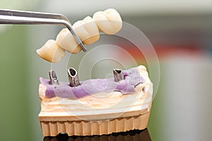 Dental implant head and bridge