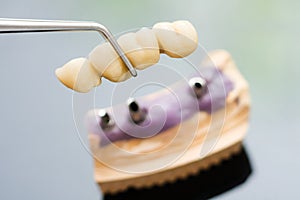 Dental implant head and bridge