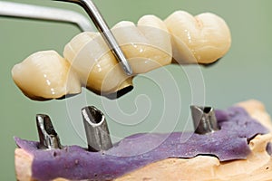 Dental implant head and bridge photo