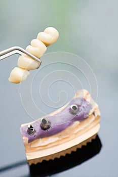 Dental implant head and bridge