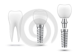 Dental implant, healing abutment or cap, crown. Artificial tooth, stages of implantation. photo