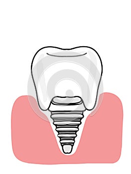 dental implant illustration cartoon icon and gingival white colors