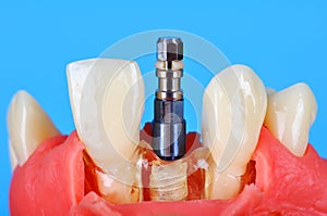 Dental implant implanted in jaw