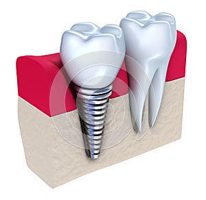 Zahnimplantat implantiert im kieferknochen 