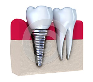 Zubní implantát implantovaný v čelistní kosti 