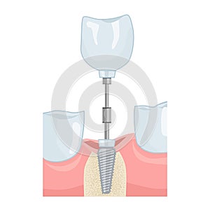 Dental implant insertion. Dental services. Vector illustration for dental textbooks