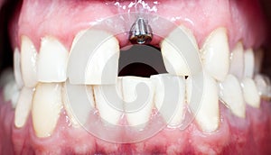 Dental implant photo