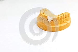 Dental implant. Making dentures in a dental laboratory. Jaw with teeth on a white background. Dental clinic