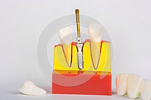 Dental Implant Model. Modern stomatology concept. Selective focus. Space for text.