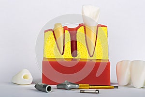 Dental Implant Model. Modern stomatology concept. Selective focus. Space for text.