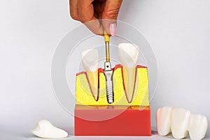 Dental Implant Model. Modern stomatology concept. Selective focus. Space for text.