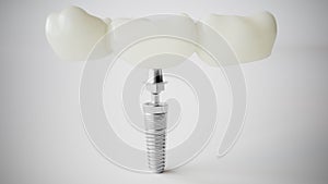Dental Implant: Modern Solution for Tooth Replacement