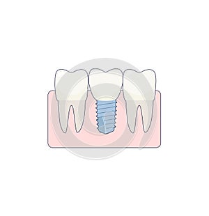 A dental implant placed between two healthy teeth, the abutment is covered with a crown. ivector illustration, in a flat