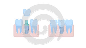 A dental implant placed between two healthy teeth, the abutment is covered with a crown. vector illustration, in a flat