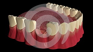 Dental implant procedure