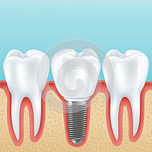 Dental implant realistic illustration