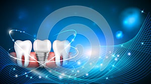 Dental implant scientific modern design