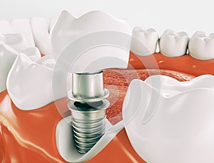 Dental implant - Series 2 of 3 - 3d rendering