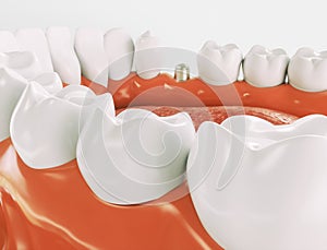 Dental implant - Series 3 of 3 - 3d rendering