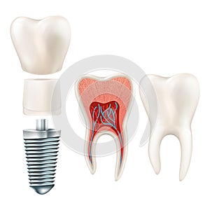 Dental implant set. EPS 10