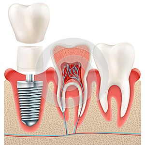 Dental implant set. EPS 10