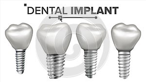 Dental Implant Set Vector. Implant Structure. Crown, Abutment, Screw. Care, Stomatology. Realistic Isolated Illustration