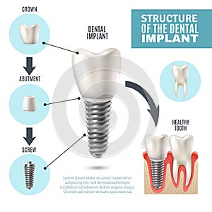 Dental Implant Structure Medical Infographic Poster