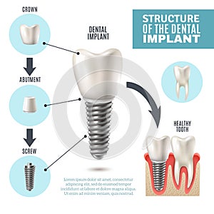 Dental Implant Structure Medical Infographic Poster photo