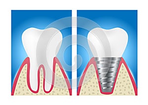 Dental implant structure medical / tooth and teeth concept vector