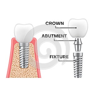 Dental implant structure realistic schematic. Implantation sequence. Fixture, abutment, crown. photo