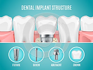 Dental implant structure. Vector reallistic tooth implant cut. Dental surgery banner photo