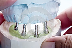 Dental implant temporary abutment photo