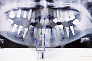 Dental Implant and tooth radiography