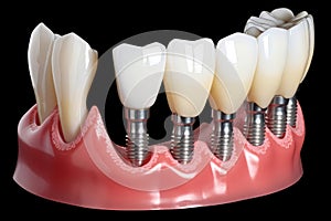 Dental implant treatment care oral. Generate Ai