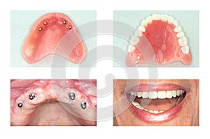 Dental implant of upper jaw photo