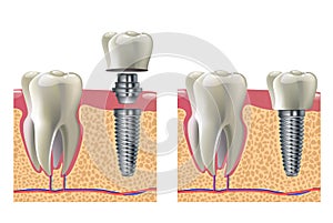 Dental implant vector illustration - humant teeth medical infographic poster
