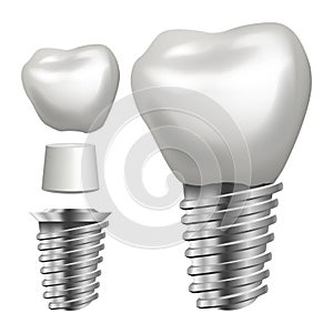 Dental Implant Vector. Side View. Graphic Design Element. Tooth Paste Poster. Realistic Isolated Illustration