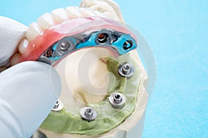 Dental implant work is completed and ready to use.