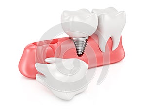 Dental implantation concept