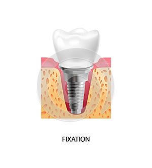 Dental Implantation Fixation Composition