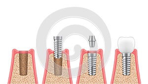 Dental implantation process steps, timeline realistic set. Placement implant, abutment, crown.