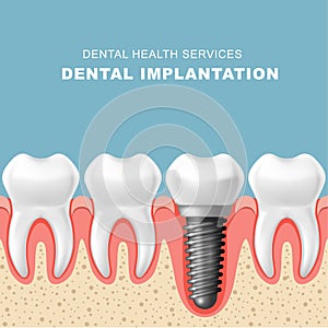 Dental implantation - row of teeth, gum with implant