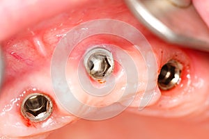 Implantes dentales 